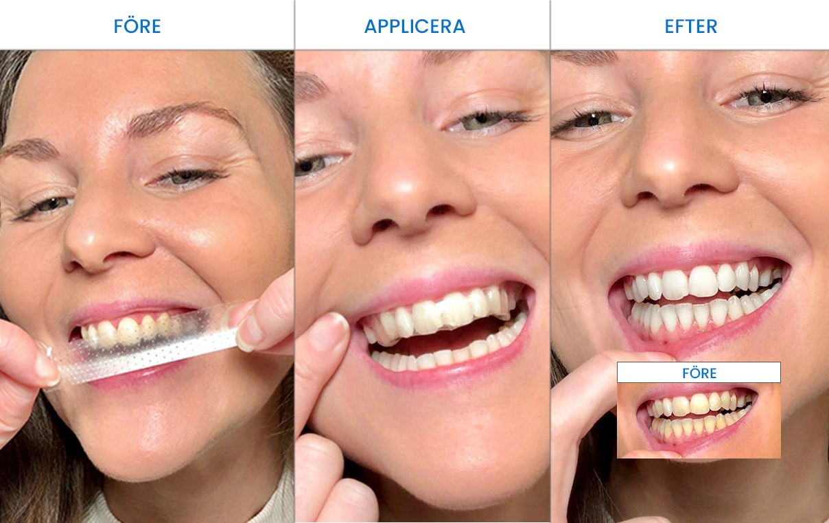 whitening-stipe